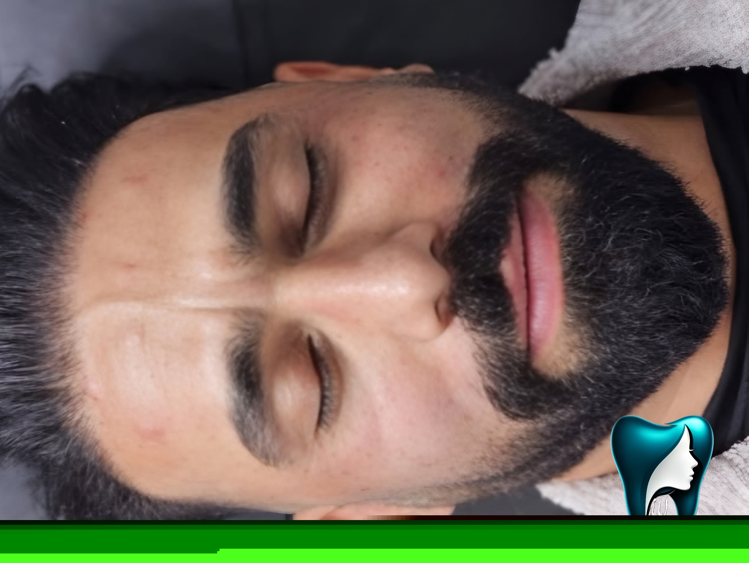 عکس تزریق بوتاکس