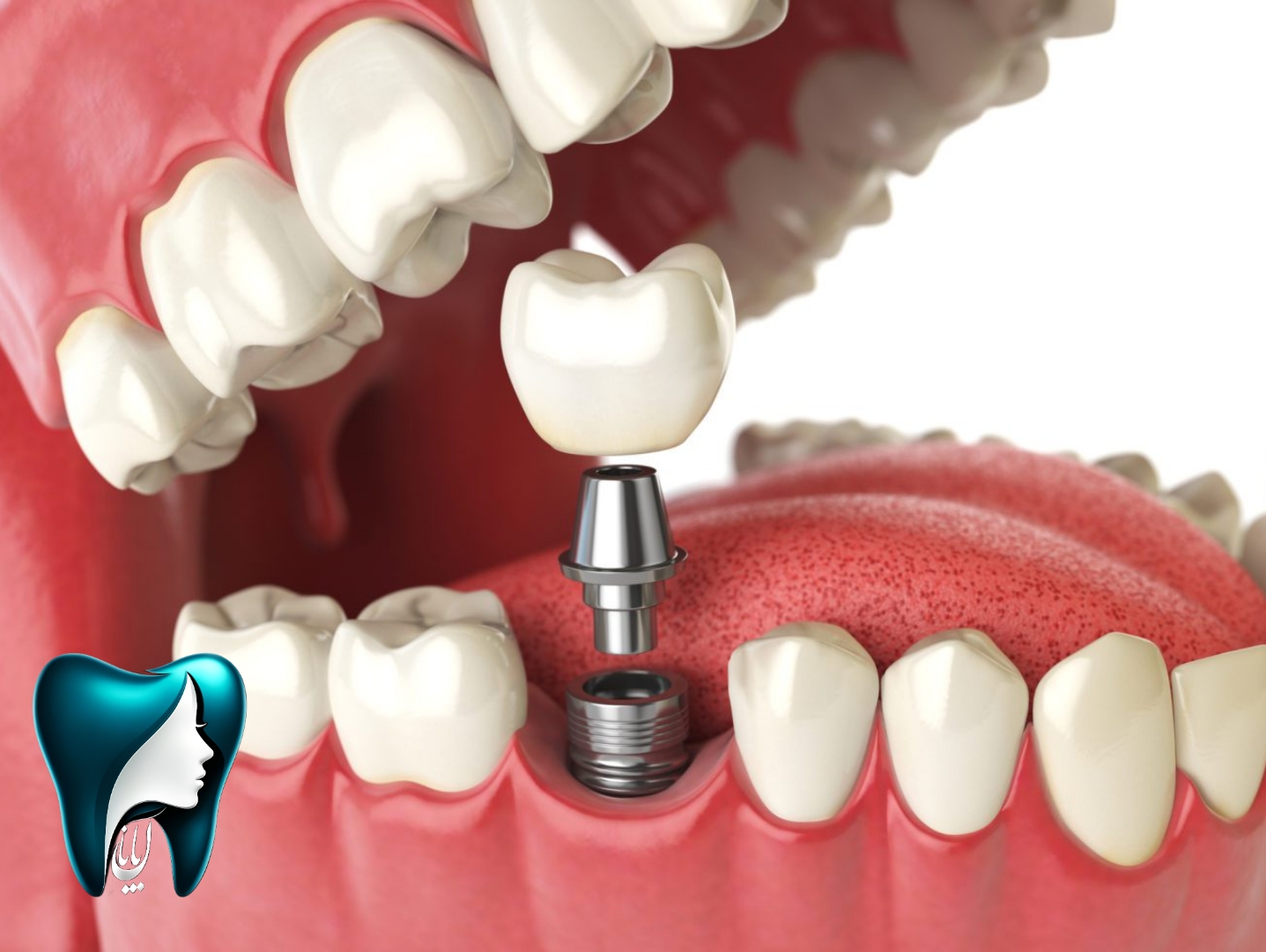 عکس ایمپلنت دندان