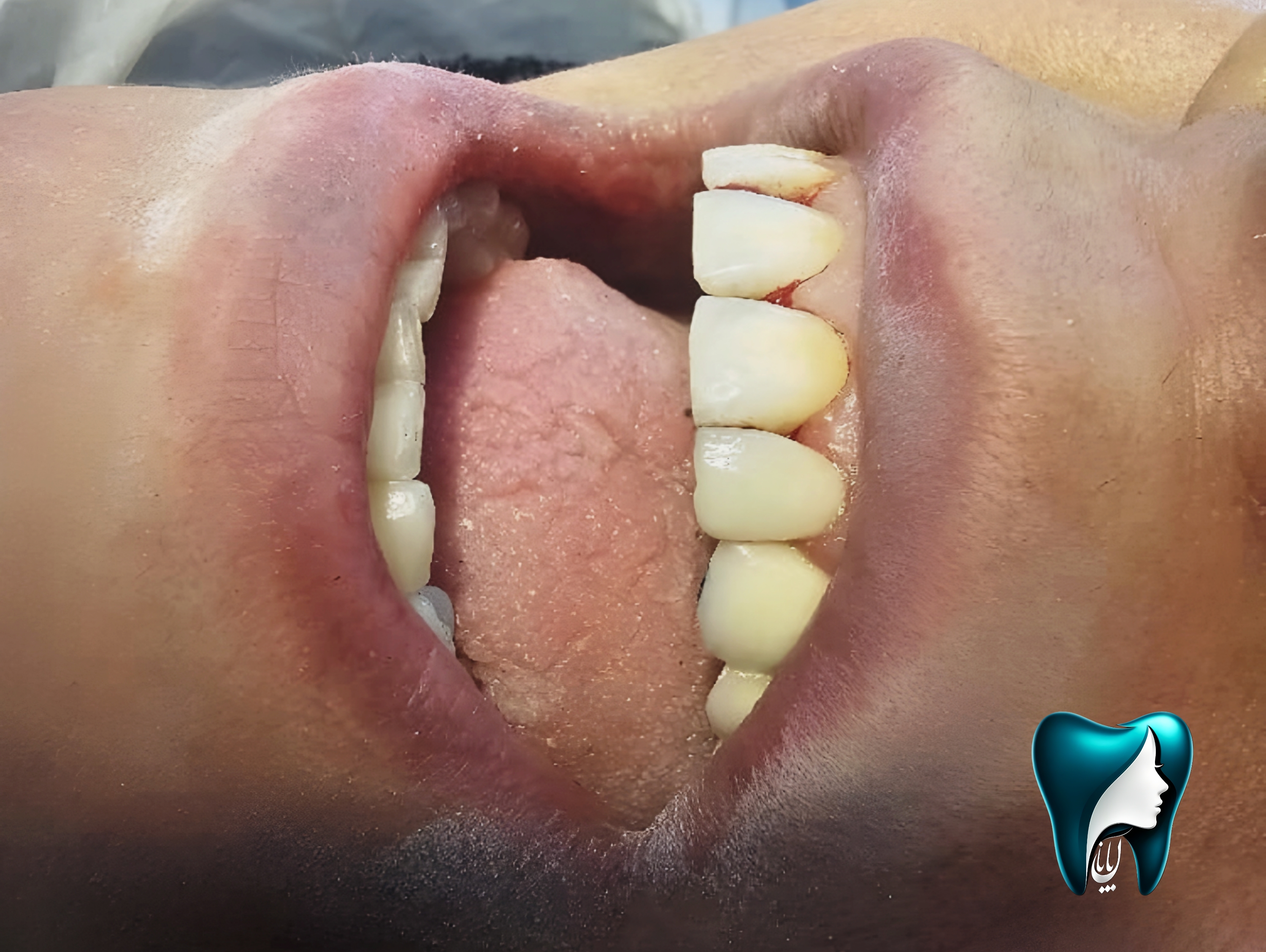 عکس لمینیت و ونیر